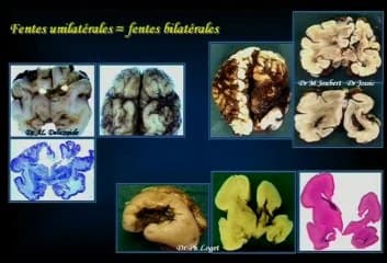 Schizencéphalie : aspects neuropathologiques