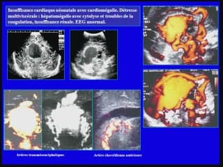 anevrysme de la veine de GALIEN