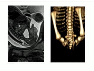 Limited dosal myeloschisis