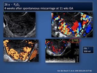 Malformations artério-veineuses utérines acquises › Réalité, fiction, prise en charge