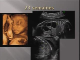 Concept d'hypertrophie compensatrice du rein : approche échographique.