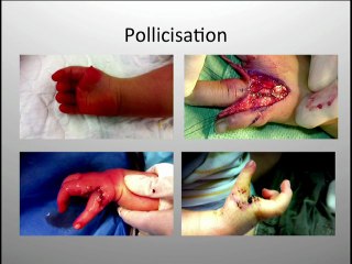Les Centres de référence Maladies Rares : malformations des membres de l'enfant et de l'arthrogrypose