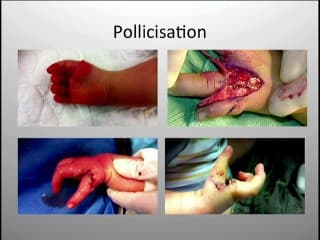 Les Centres de référence Maladies Rares : malformations des membres de l'enfant et de l'arthrogrypose