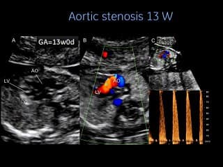 Malformations cardiaques : Qu'attendre de l'examen du coeur au premier trimestre ?