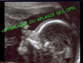 Quand demander un caryotype foetal devant un signe échographique au 2eme trimestre ? SNC. Kystes des plus choroïdes, Face et OPN courts