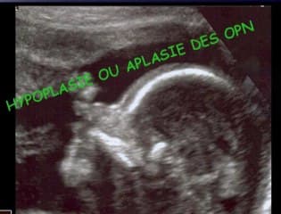 Quand demander un caryotype foetal devant un signe échographique au 2eme trimestre ? SNC. Kystes des plus choroïdes, Face et OPN courts