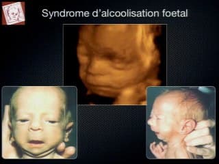 Imagerie et étiologie des microrétrognathismes