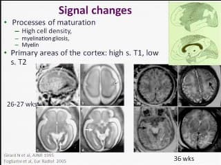 la gyration foetale  ( en ANGLAIS )