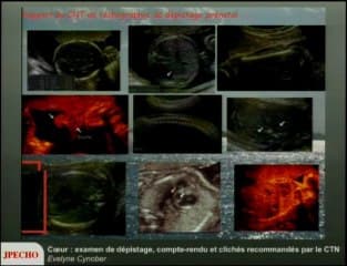 Coeur : l’examen de dépistage , le compte-rendu et les deux clichés recommandés par le Comité Technique National (CTN)
