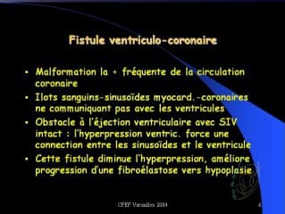 Fistule ventriculocoronaire