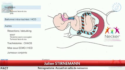 Rétrognatisme et masses oropharyngées : prise en charge néonatale* › Accueil en salle de naissance, évaluation prénatale de l’intubabilité, naissance inopinée