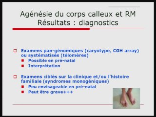 Le corps calleux : génétique et retard mental.