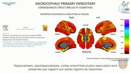 44 Projet de recherche : facteurs pronostiques prédictifs  des microcéphalies de DPN