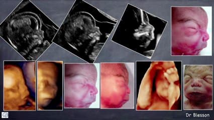 syndrome de CORNELIA DELANGE