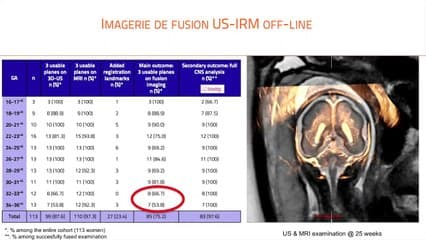 Imagerie de fusion dans les infections : intérêt dans l’évaluation pronostique