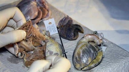 Coeur foetal - Les pathologies cono-troncales Embryologie : démonstration