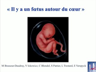 Coeur : Anomalie cardiaque associée : CHARGE