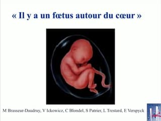 Coeur : Anomalie cardiaque associée : CHARGE