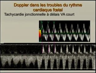 Trouble du rythme : place du doppler ?