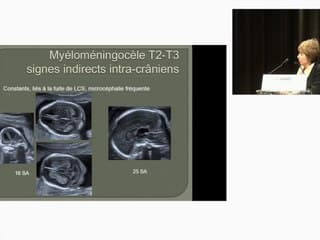 Limited dorsal myeloschisis : le Canada Dry de la myéloméningocèle.