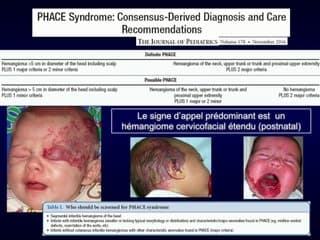 Cas clinique : A propos d’un cas de syndrome PHACES. Données cardiopédiatrique et de génétique