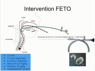Hernie diaphragmatique : plug/unplug (vidéo)