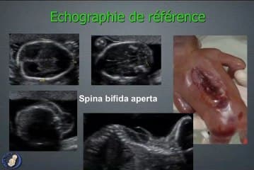 Dilatation ventriculaire cérébrale foetale