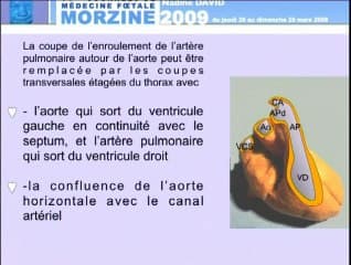 Limites et pièges de la coupe des gros vaisseaux recommandée par le Comité National Technique de l’Échographie de Dépistage Prénatal Les alternatives