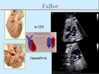Coeur foetal - Les pathologies cono-troncalesAspects échographiques des pathologies cono-troncales