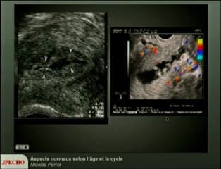 Endomètre Aspects normaux selon l’âge et le cycle