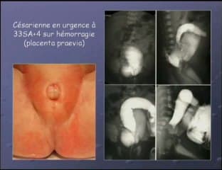Dilatation pseudo digestive