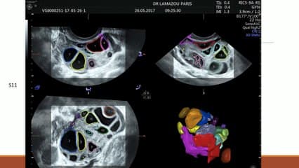 Monitorage de l'ovulation Live on demand