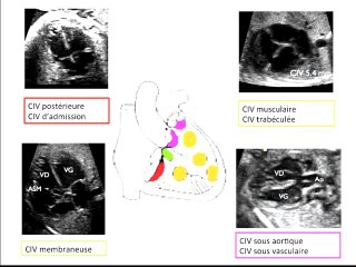 Petits signes d'appel écho cardiographiques et proposition de caryotype foetal : pratique des membres du club
