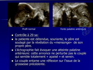 Ectrodactylie
