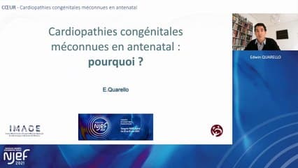 Cardiopathies congénitales méconnues en anténatal