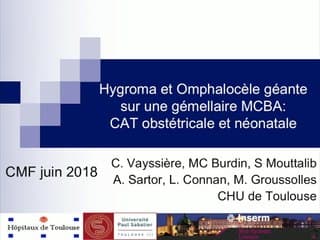2 Omphalocèle géante sur un jumeau (G mono-bi): CAT obstétricale et néonatale