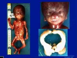 Malformations cardiaques et examen foetopathologique