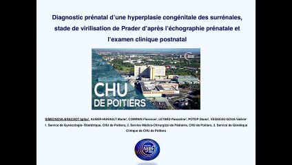 Diagnostic prénatal d'une hyperplasie congénitale des surrénales.