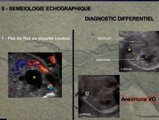 Image kystique intra-abdominale