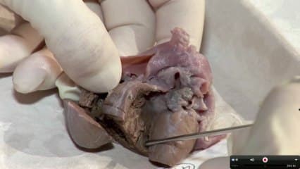 TGV et anomalie des gros vaisseaux live