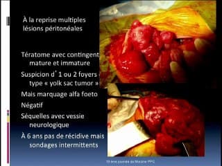 Tumeurs foetales : Evolution postnatale des tumeurs thoraciques et abdominales