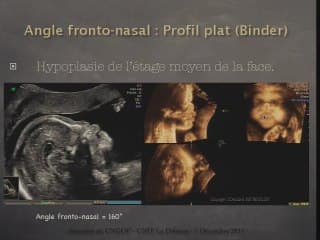 Dépistage des malformations de la face