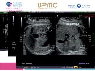 Diagnostic prénatal des atrésies des voies biliaires : un aspect inhabituel de la vésicule biliaire à connaitre