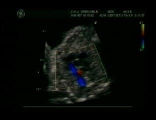 L’hémodynamique des coeurs pathologiques. Tétralogie de Fallot