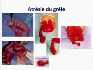 Quelques quizz en imagerie de l’abdomen : duo échographiste-chirurgien.