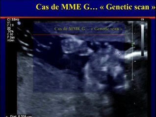 Échographie du 2ème trimestre : valeur des petits signes statistiques pour les nuls ou comment faire un calcul de risque intégré ? Vous avez dit genetic scan ?