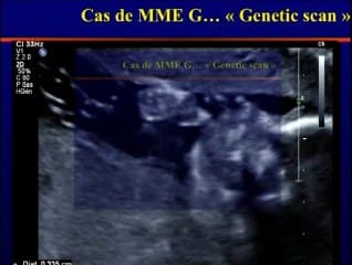 Échographie du 2ème trimestre : valeur des petits signes statistiques pour les nuls ou comment faire un calcul de risque intégré ? Vous avez dit genetic scan ?