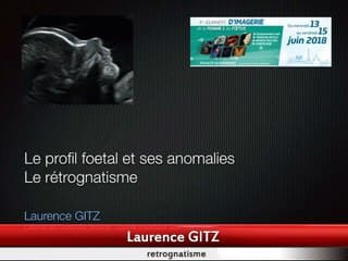 Profil fœtal et ses anomalies, rétrognatisme