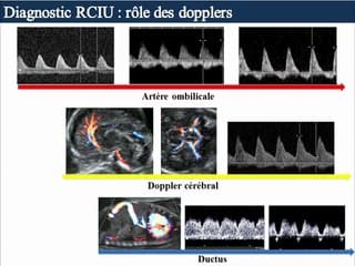 PAG et RCIU Pronostic neurologique du RCIU : apport de l'échographie et de l'IRM