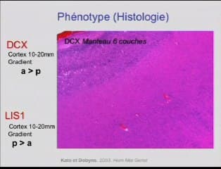 Les reflets neuropathologiques des anomalies de la gyration